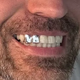 Bling Cartel Admin Rings 925 Sterling Silver Double Side Canine Teeth Caps Custom Grillz
