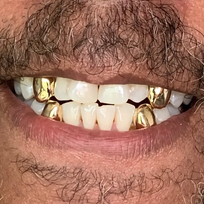 Gold Plated over 925 Sterling Silver Custom Single Teeth Caps Bling Cartel Admin Rings